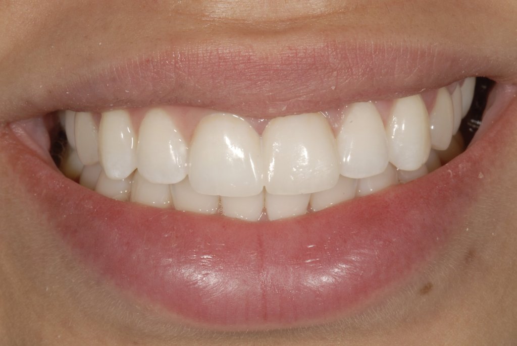 up-close photo After Single Veneers