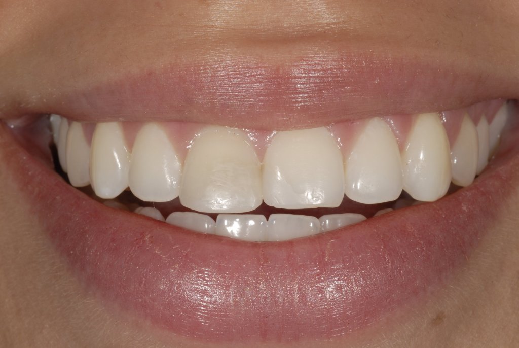 up-close photo Before Single Veneer